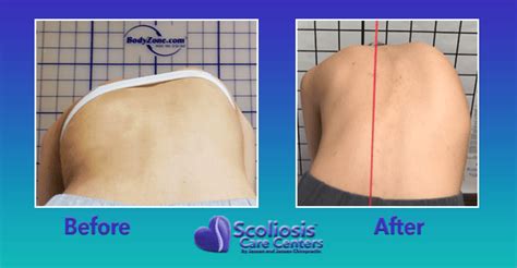 rib flare scoliosis|scoliosis and rib arch pain.